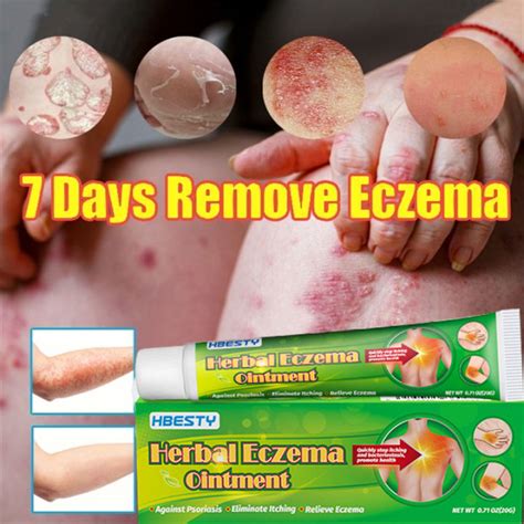moisturizing cream in tagalog|Gamot sa Skin Asthma: Treatment for Eczema (Atopic Dermatitis).